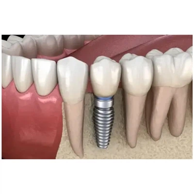 Kuru abatmentu izvēlēties zobu implantu atjaunošanai?