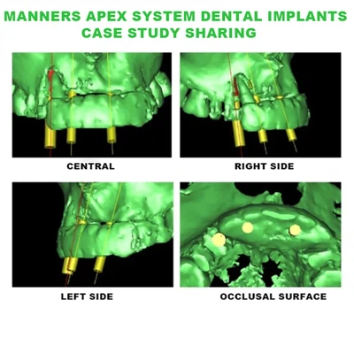 Manieru virsotnes sistēmas tūlītēja implantācija augšžokļa priekšējā daļā ar ...