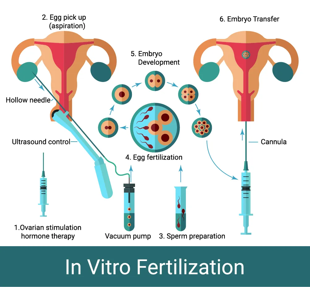 Dažādu izmēru olu iegūšanas adatu efektivitāte IVF procedūrās