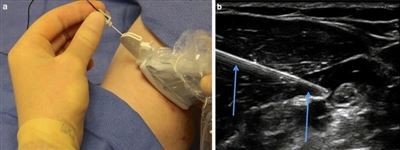 Ultraskaņas loma nervu bloka adatas precizitātes uzlabošanā